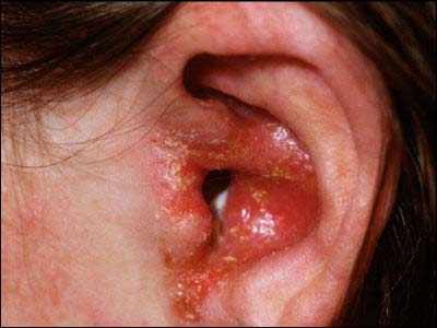 ear infections - otitis